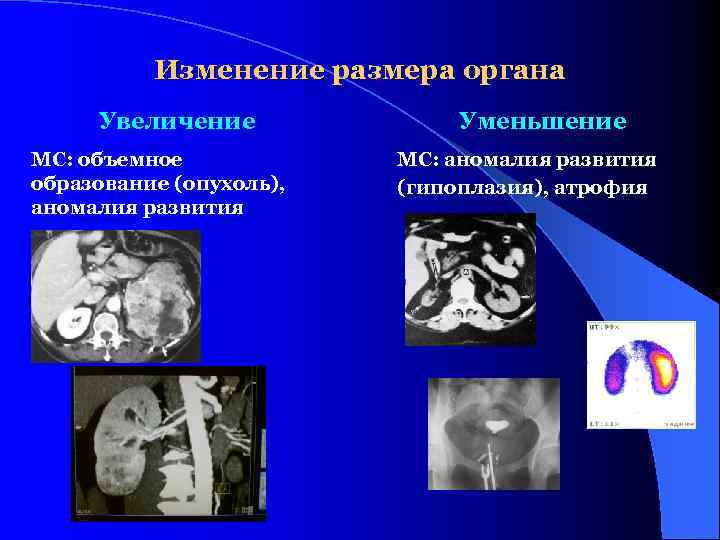 Изменение размера органа Увеличение МС: объемное образование (опухоль), аномалия развития Уменьшение МС: аномалия развития