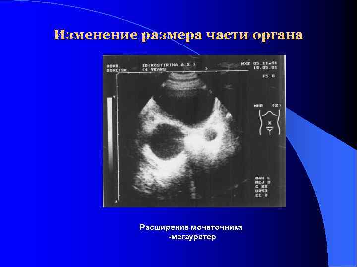 Изменение размера части органа Расширение мочеточника -мегауретер 