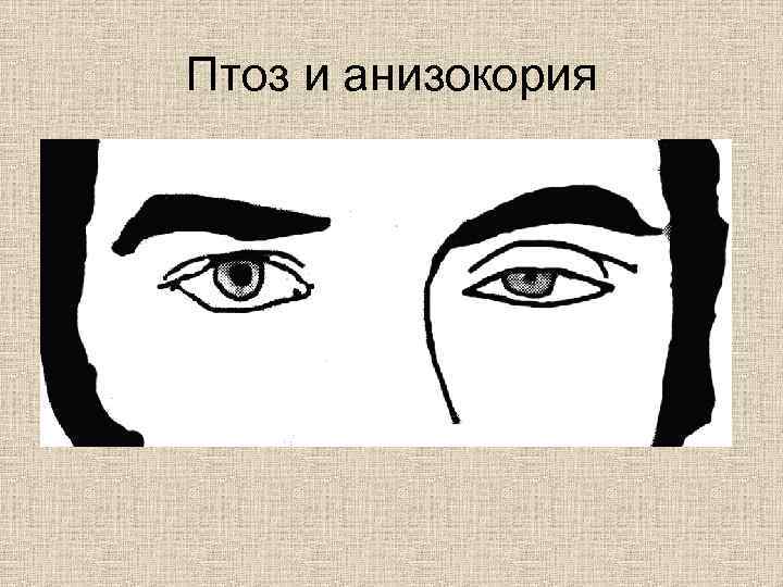 Птоз и анизокория 