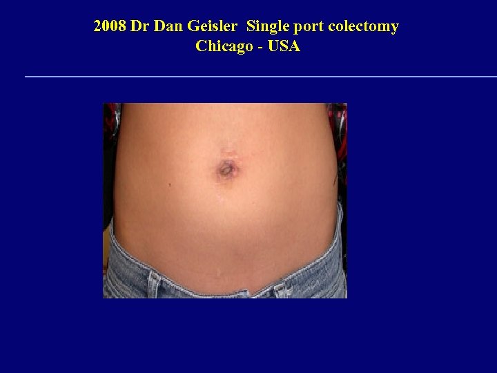 2008 Dr Dan Geisler Single port colectomy Chicago - USA 