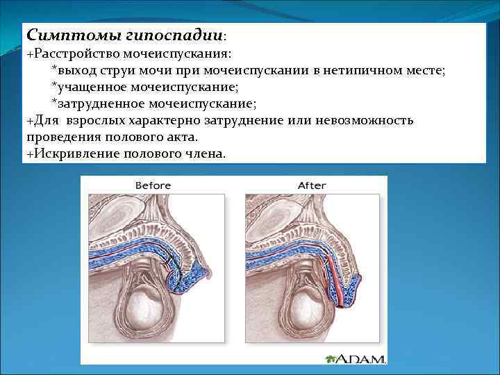Симптомы гипоспадии: +Расстройство мочеиспускания: *выход струи мочи при мочеиспускании в нетипичном месте; *учащенное мочеиспускание;