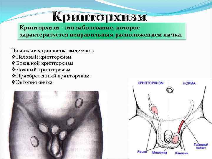 Крипторхизм – это заболевание, которое характеризуется неправильным расположением яичка. По локализации яичка выделяют: v.