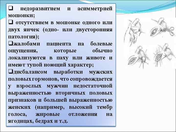 q недоразвитием и асимметрией мошонки; q отсутствием в мошонке одного или двух яичек (одно-