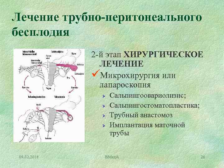 Лечение трубно-перитонеального бесплодия 2 й этап ХИРУРГИЧЕСКОЕ ЛЕЧЕНИЕ üМикрохирургия или лапароскопия Ø Ø 09.