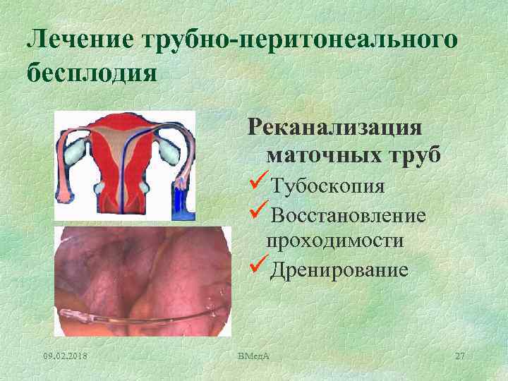 Лечение трубно-перитонеального бесплодия Реканализация маточных труб üТубоскопия üВосстановление проходимости üДренирование 09. 02. 2018 ВМед.