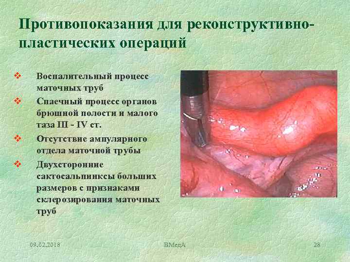 Противопоказания для реконструктивнопластических операций v v Воспалительный процесс маточных труб Спаечный процесс органов брюшной