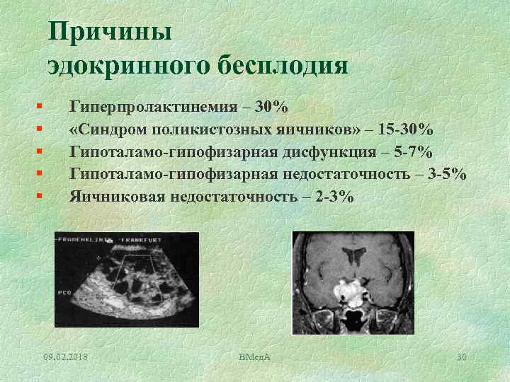 Причины эдокринного бесплодия § § § Гиперпролактинемия – 30% «Синдром поликистозных яичников» – 15