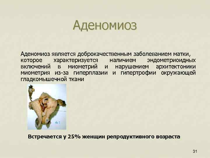 Аденомиоз является доброкачественным заболеванием матки, которое характеризуется наличием эндометриоидных включений в миометрий и нарушением