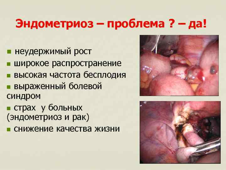 Эндометриоз – проблема ? – да! неудержимый рост n широкое распространение n высокая частота