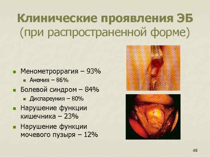 Клинические проявления ЭБ (при распространенной форме) n Менометроррагия – 93% n n Болевой синдром