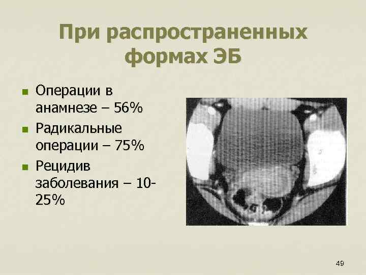 При распространенных формах ЭБ n n n Операции в анамнезе – 56% Радикальные операции