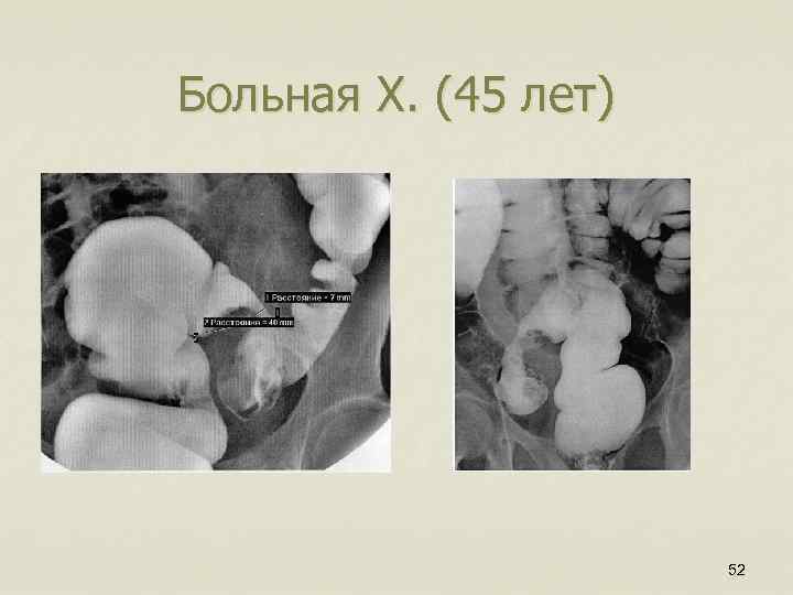 Больная Х. (45 лет) 52 