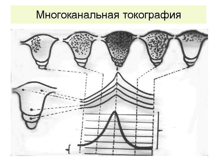 Многоканальная токография 