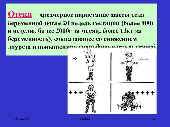 Отеки – чрезмерное нарастание массы тела беременной после 20 недель гестации (более 400 г