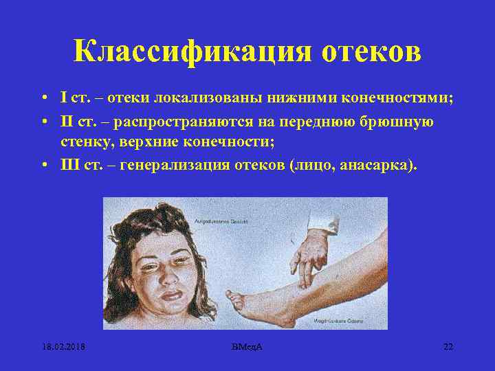 Классификация отеков • I ст. – отеки локализованы нижними конечностями; • II ст. –