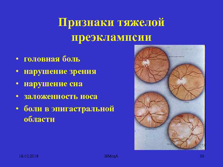 Признаки тяжелой преэклампсии • • • головная боль нарушение зрения нарушение сна заложенность носа