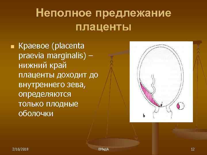 Неполное предлежание плаценты n Краевое (placenta praevia marginalis) – нижний край плаценты доходит до