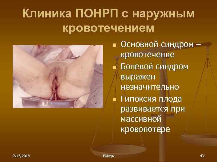 Клиника ПОНРП с наружным кровотечением n n n 2/16/2018 ВМед. А Основной синдром –
