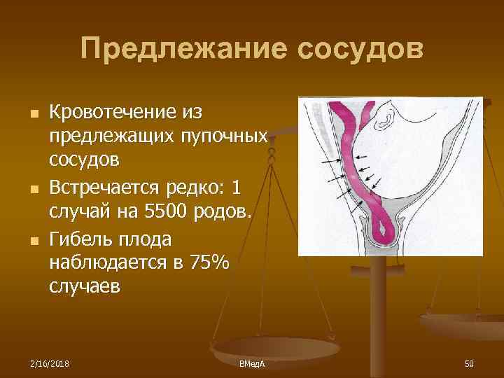 Предлежание сосудов n n n Кровотечение из предлежащих пупочных сосудов Встречается редко: 1 случай