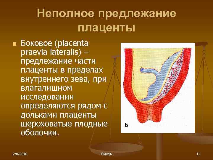Неполное предлежание плаценты n Боковое (placenta praevia lateralis) – предлежание части плаценты в пределах
