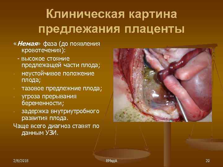 Клиническая картина предлежания плаценты «Немая» фаза (до появления кровотечения): - высокое стояние предлежащей части