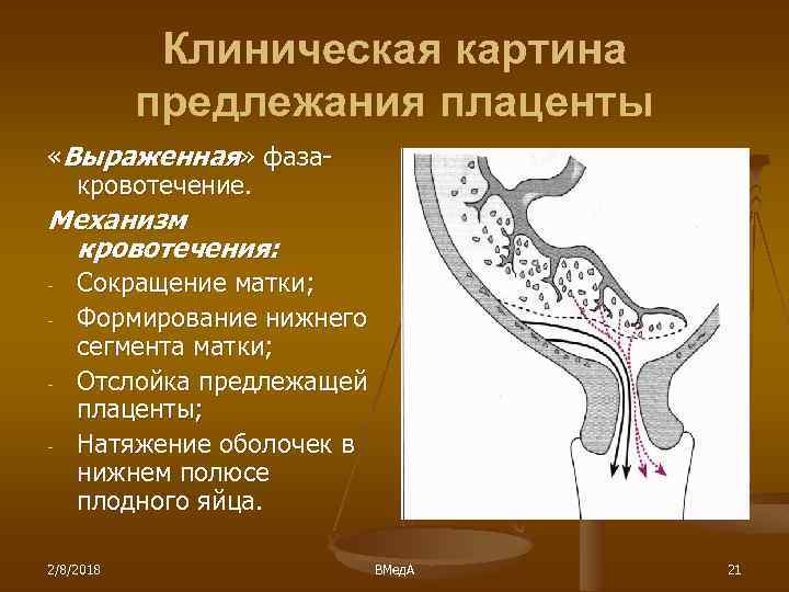 Клиническая картина предлежания плаценты «Выраженная» фазакровотечение. Механизм кровотечения: - Сокращение матки; Формирование нижнего сегмента