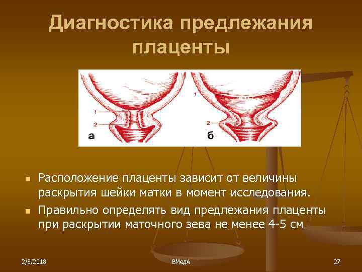 Диагностика предлежания плаценты n n Расположение плаценты зависит от величины раскрытия шейки матки в