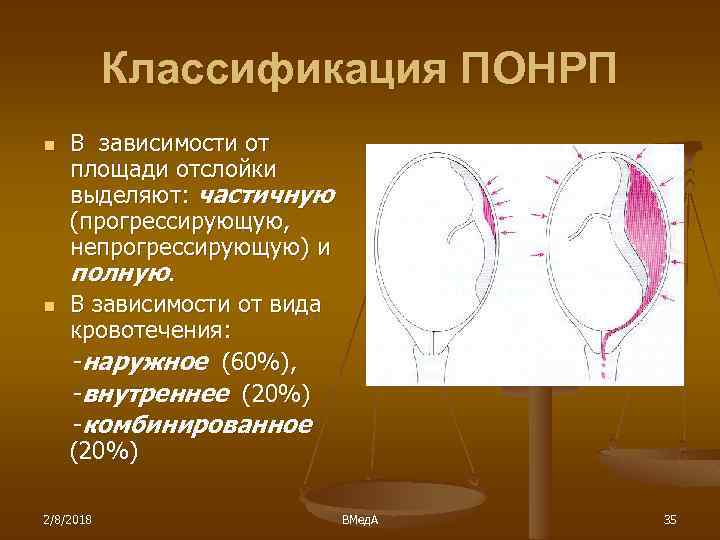 Классификация ПОНРП n n В зависимости от площади отслойки выделяют: частичную (прогрессирующую, непрогрессирующую) и