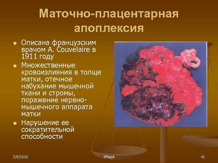 Маточно-плацентарная апоплексия n n n Описана французским врачом A. Couvelaire в 1911 году Множественные