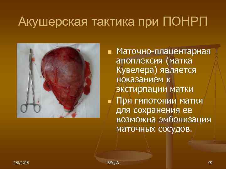 Акушерская тактика при ПОНРП n n 2/8/2018 Маточно-плацентарная апоплексия (матка Кувелера) является показанием к