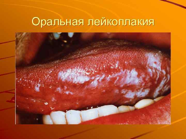 Оральная лейкоплакия 