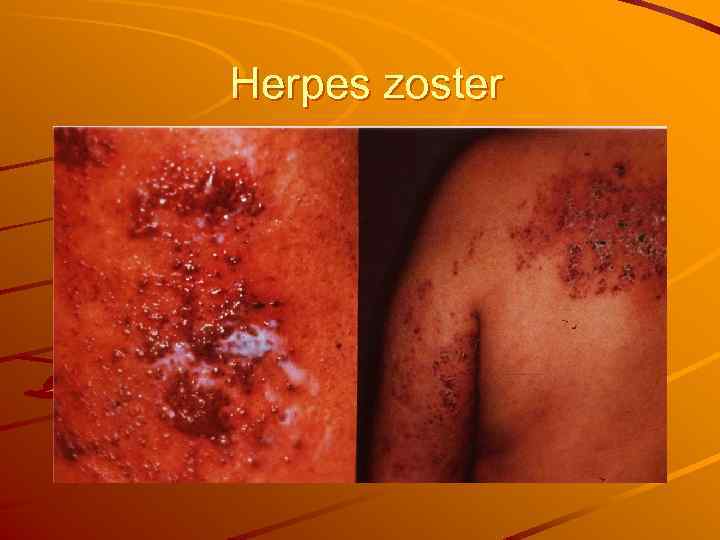 Herpes zoster 