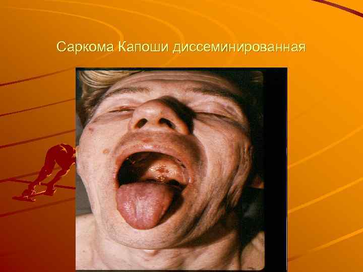 Саркома Капоши диссеминированная 