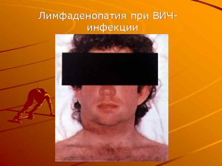 Лимфаденопатия при ВИЧинфекции 