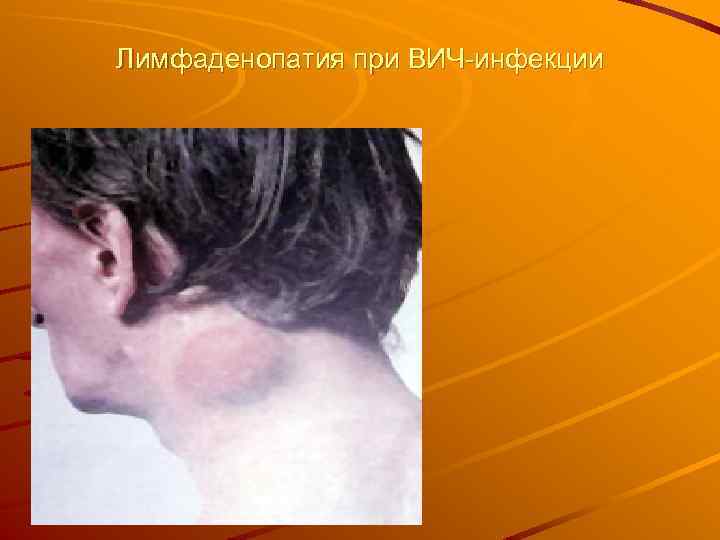 Лимфаденопатия при ВИЧ-инфекции 