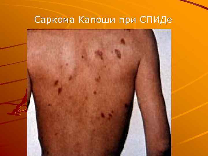 Саркома Капоши при СПИДе 