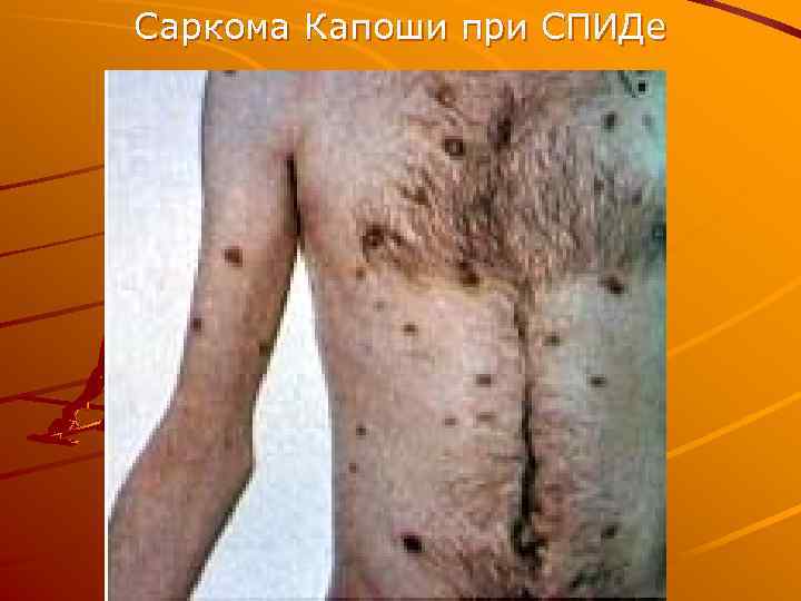 Саркома Капоши при СПИДе 