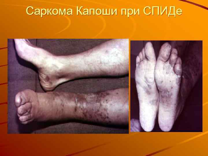 Саркома Капоши при СПИДе 