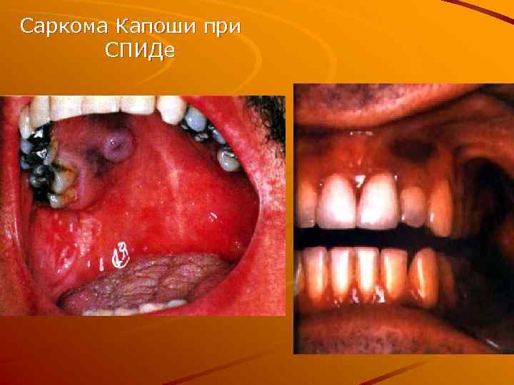 Саркома Капоши при СПИДе 
