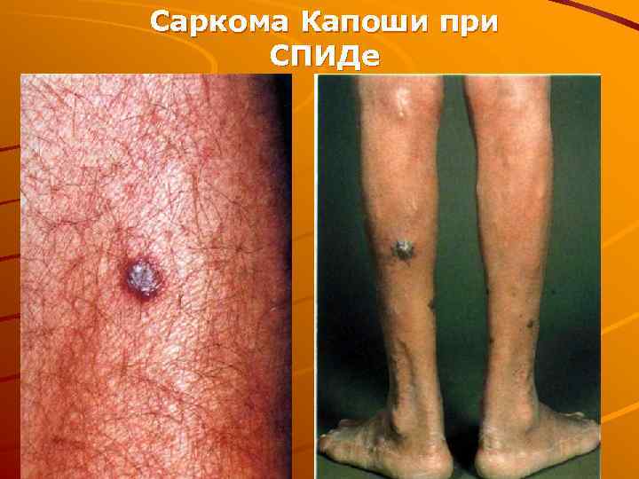 Саркома Капоши при СПИДе 