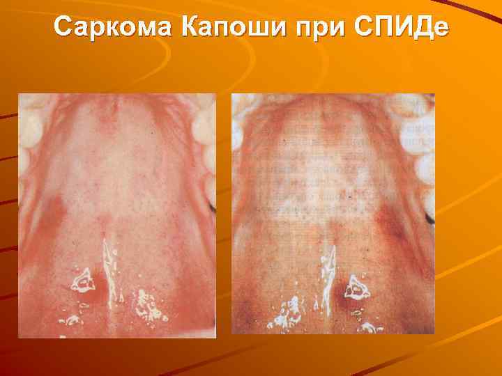 Саркома Капоши при СПИДе 