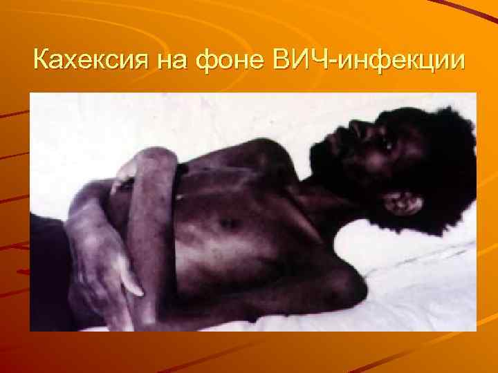 Кахексия на фоне ВИЧ-инфекции 