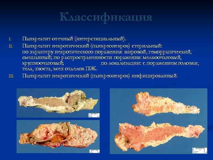 Классификация I. II. III. Панкреатит отечный (интерстициальный). Панкреатит некротический (панкреонекроз) стерильный: по характеру некротического