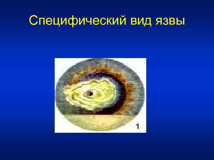 Специфический вид язвы 