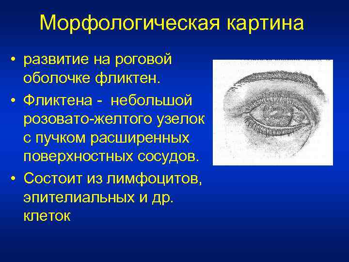 Морфологическая картина • развитие на роговой оболочке фликтен. • Фликтена - небольшой розовато-желтого узелок