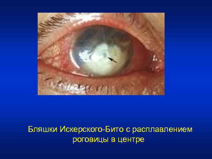  Бляшки Искерского-Бито с расплавлением роговицы в центре 