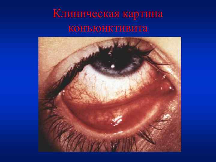 Клиническая картина конъюнктивита 