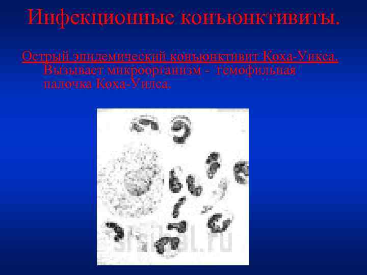 Инфекционные конъюнктивиты. Острый эпидемический конъюнктивит Коха-Уикса. Вызывает микроорганизм - гемофильная палочка Коха-Уилса. 
