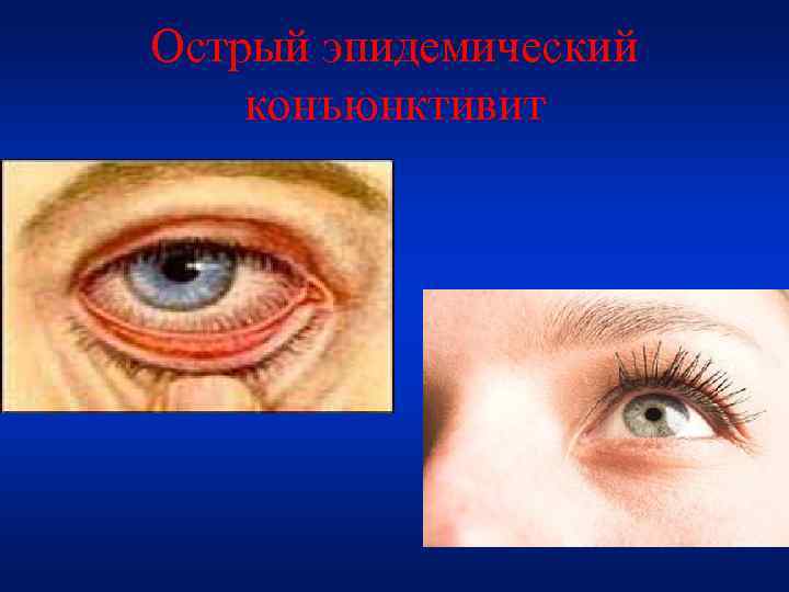 Острый эпидемический конъюнктивит 
