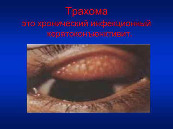 Трахома это хронический инфекционный кератоконъюнктивит. 